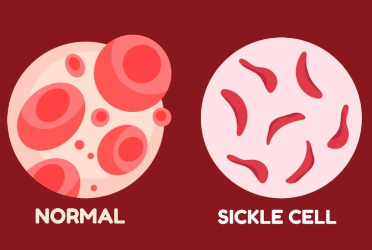 Sickle cell disease, an inherited blood disorder, has long cast a shadow over the lives of those affected