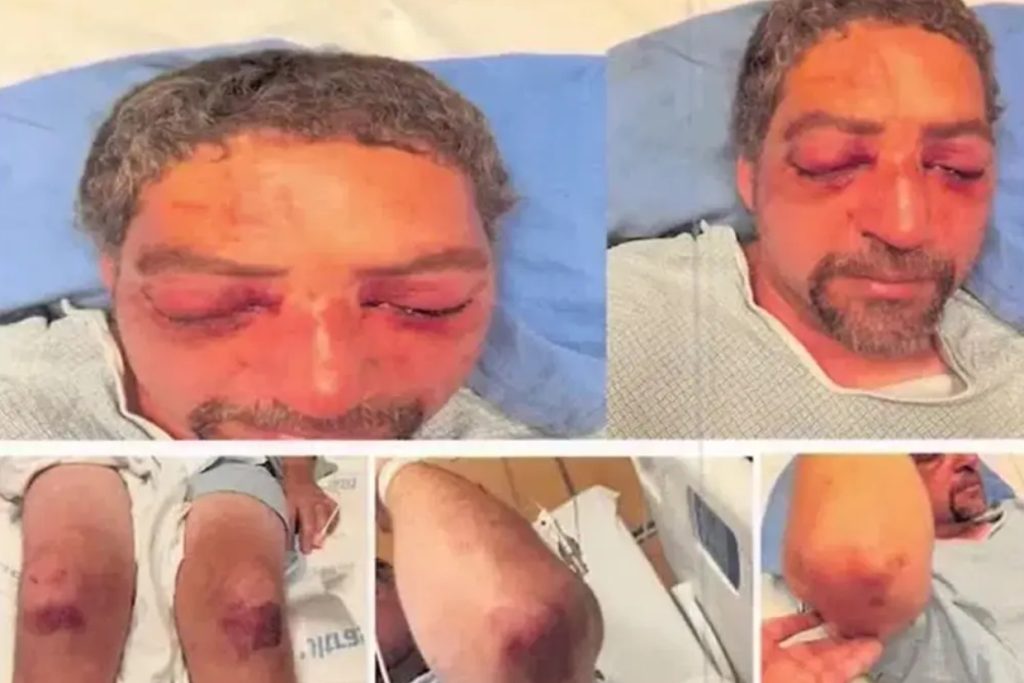 Husband’s Eyes Nearly Ripped Out in Wild Vermont Assault