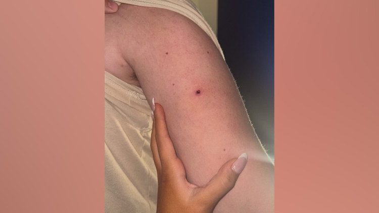 Parents say teen was stripped, shot with pellet gun in North Texas hazing incident