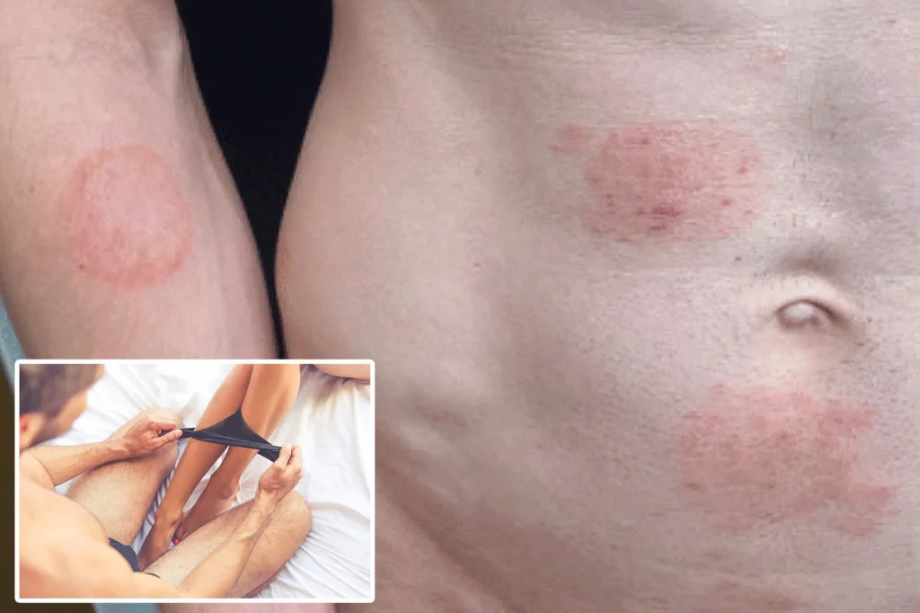 Outbreak of STI causing ringworm in unfortunate places: experts warn of the largest known outbreak