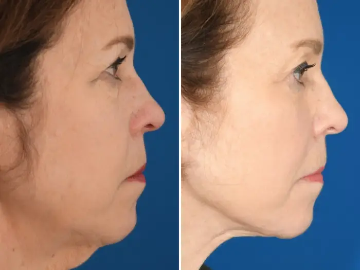 How $33,000 in Cosmetic Procedures Transformed My Career at 65