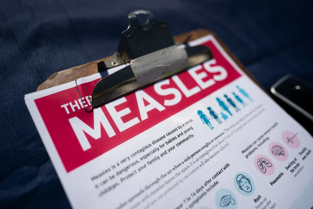 Measles Warning: 2nd Case on Long Island with Restaurant Exposure