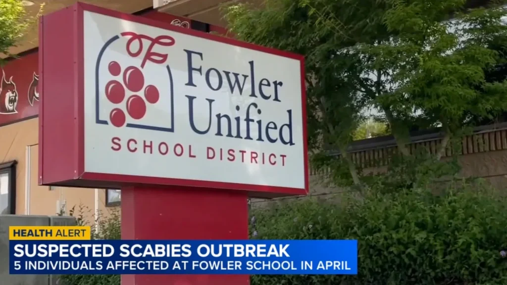 Scabies outbreak hits California school